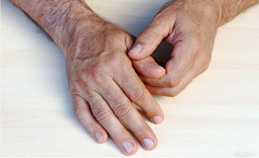 Artrose in de hand en pols: is daar echt niets aan te doen?
